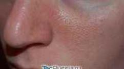 Пористая кожа — причины ее появления, симптомы и способы лечения Почему лицо становится пористым
