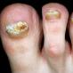 Пустота под ногтями (онихолизис): причины появления, лечение, фото