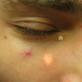 Причины появления белых точек на лице, методы лечения и профилактики
